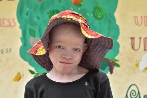 kinderen met albinisme